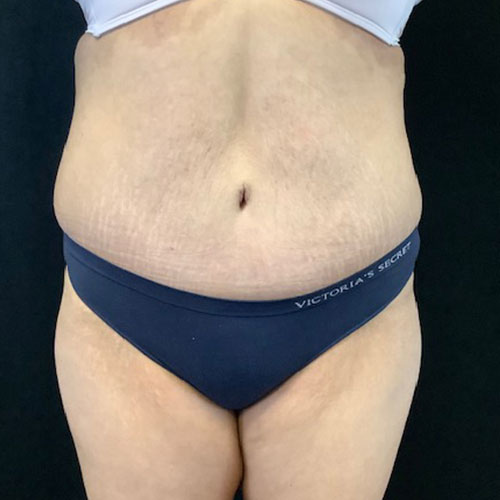 post op abdominoplasty tummy tuck surgery