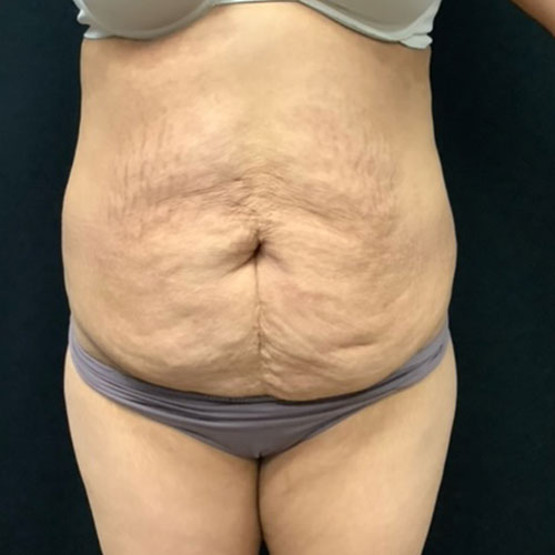 pre op abdominoplasty tummy tuck surgery