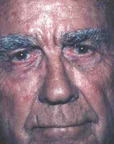 Blepharoplasty-03 | After Blepharoplasty