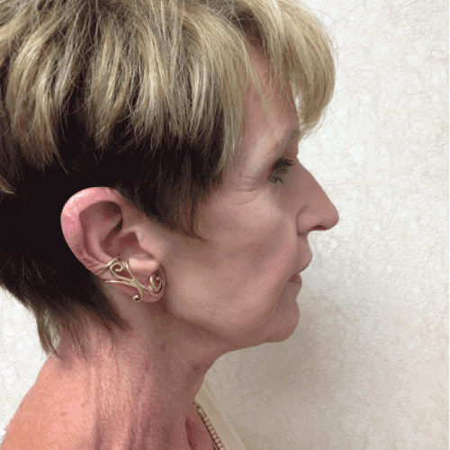 Blepharoplasty-06 | After Blepharoplasty 3
