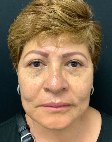post op blepharoplasty eyelid surgery
