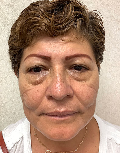 pre op blepharoplasty eyelid surgery