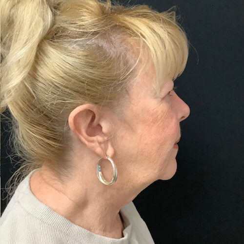 Blepharoplasty-08 | Before Blepharoplasty 3