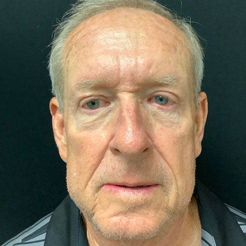 4 Months post op blepharoplasty eyelid surgery