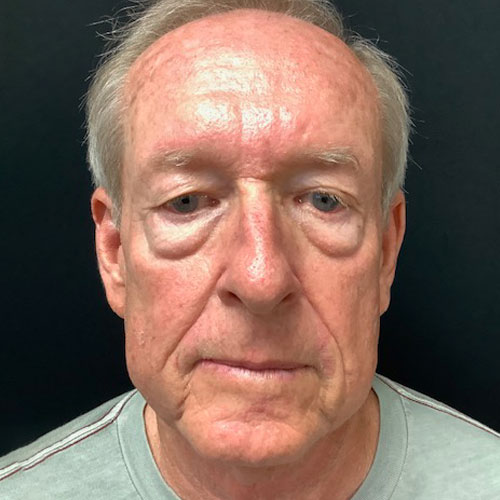 pre op blepharoplasty eyelid surgery