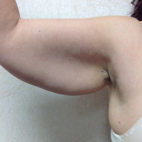 Brachioplasty-01 | Before Brachioplasty