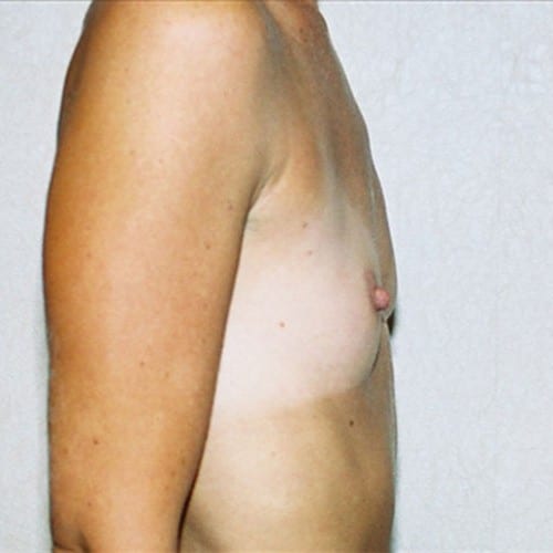 Breast-Augmentation-07 | Before Breast Augmentation 1
