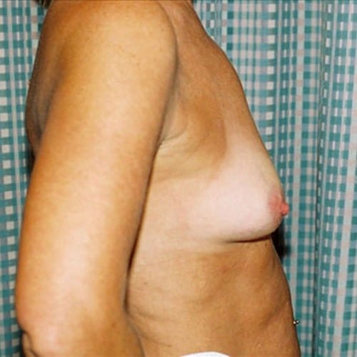 Breast-Augmentation-08 | Before Breast Augmentation 1