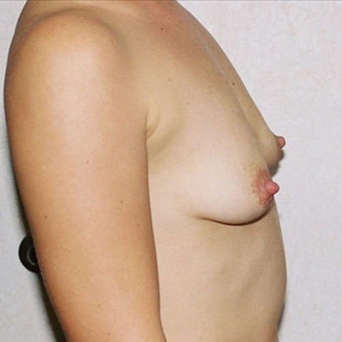 Breast-Augmentation-09 | Before Breast Augmentation 1