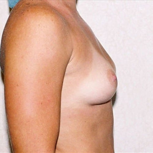 Breast-Augmentation-11 | Before Breast Augmentation 1