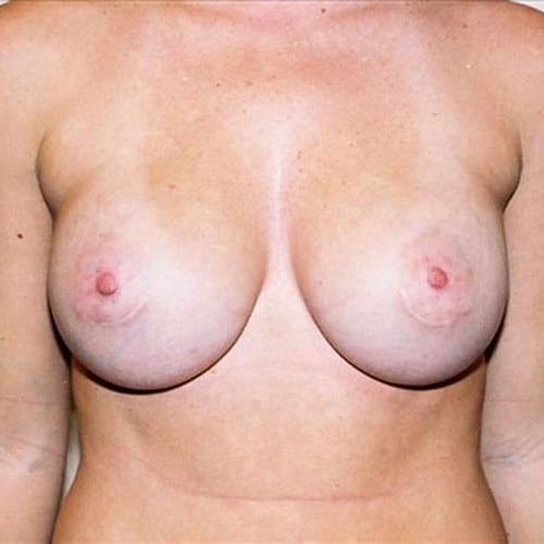 Breast-Augmentation-11 | After Breast Augmentation 2