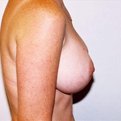 Breast-Augmentation-12 | After Breast Augmentation 1