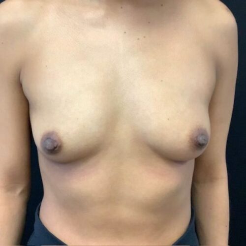 pre op breast augmentation surgery