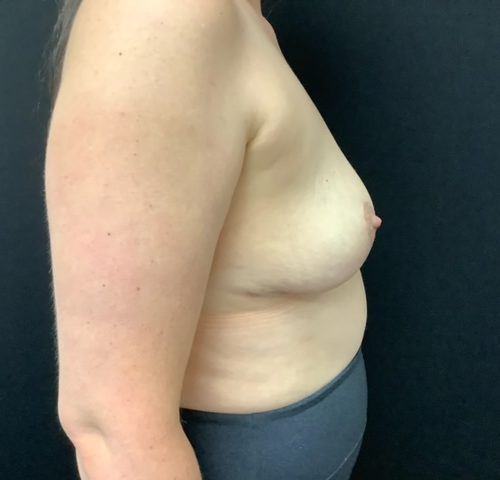 post op breast implant removal