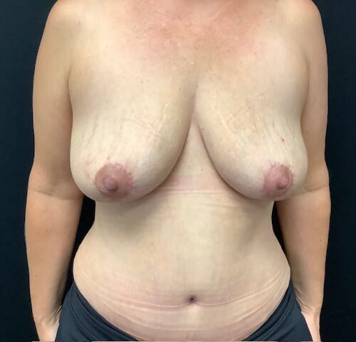 Breast-Implant-Removal-W-Lift-Patient-04 | After Breast Implant Removal With Lift