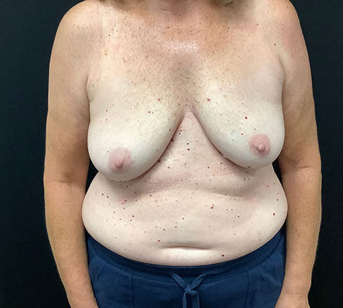 post op breast implant removal
