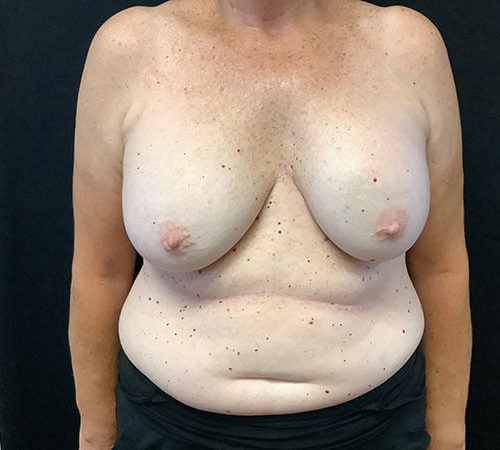pre op breast implant removal