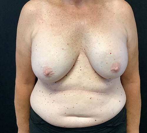 Breast-Implant-Removal-04 | Before Breast Implant Removal 2
