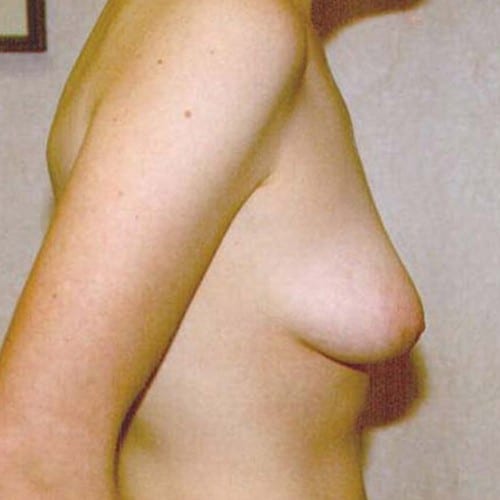 pre op breast lift surgery
