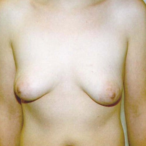 pre op breast lift surgery
