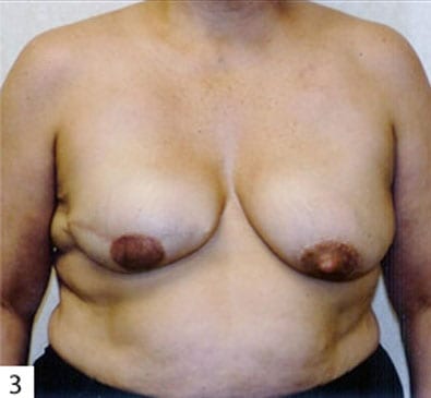 pre op breast reconstruction