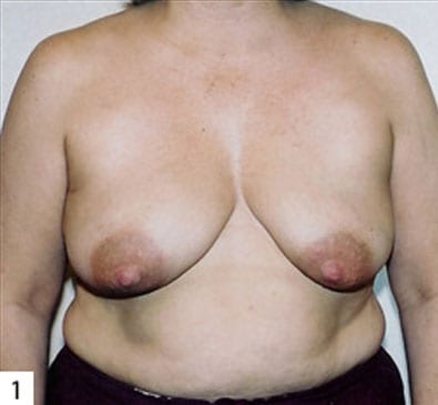 pre op breast reconstruction