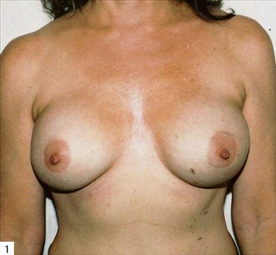 Breast-Reconstruction-02 | After Breast Reconstruction 2