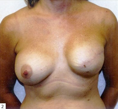 pre op breast reconstruction
