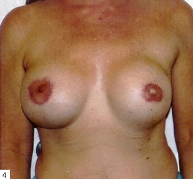 post op breast reconstruction
