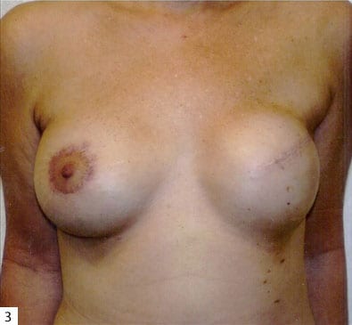 pre op breast reconstruction