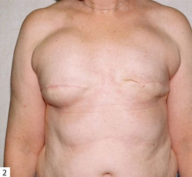 Breast-Reconstruction-05 | After Breast Reconstruction 2