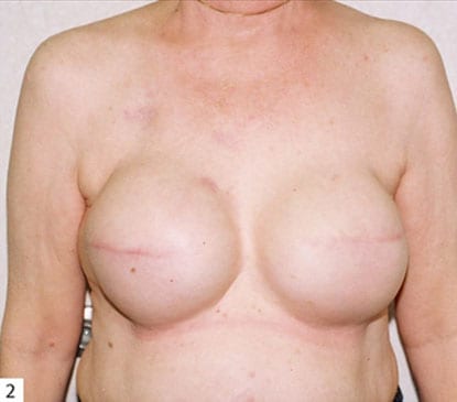 pre op breast reconstruction