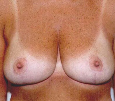 post op breast reduction