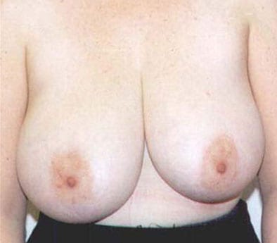 pre op breast reduction