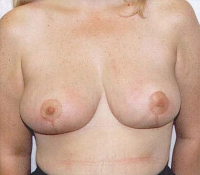 post op breast reduction