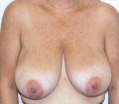 pre op breast reduction