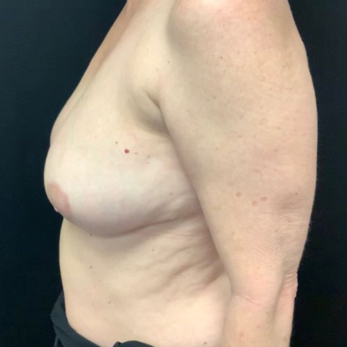 post op breast reduction