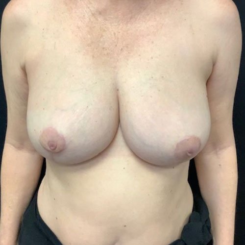post op breast reduction