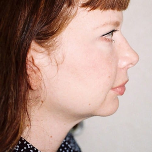 Chin-Augmentation-01 | After Chin Augmentation