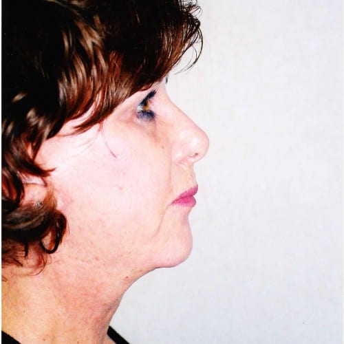 Facelift-02 | After Facelift 1