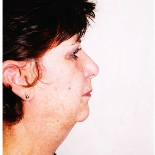 Facelift-02 | Before Facelift 1