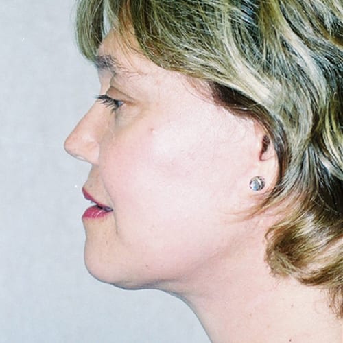 Facelift-10 | After Facelift 1
