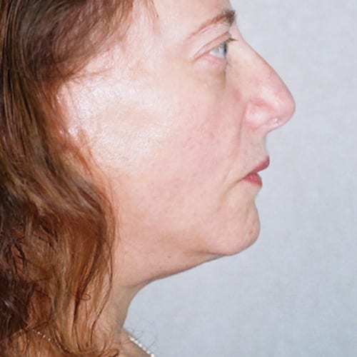 Facelift-13 | After Facelift