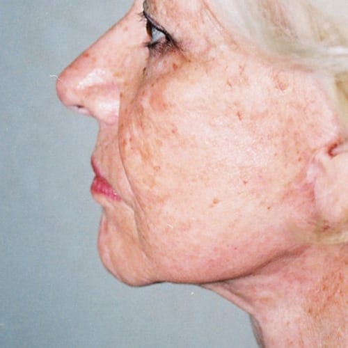 Facelift-15 | After Facelift