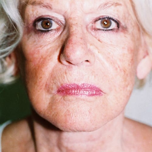Facelift-15 | After Facelift 2