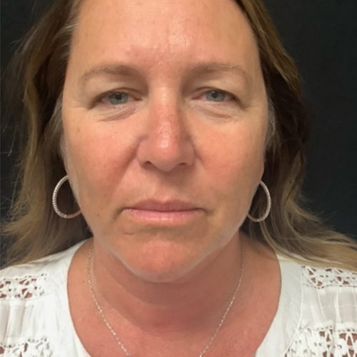 Facelift 24 Before