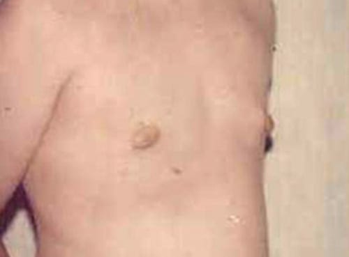 post op gynecomastia