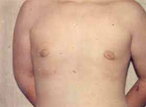 post op gynecomastia
