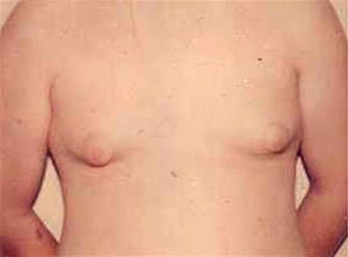 pre op gynecomastia