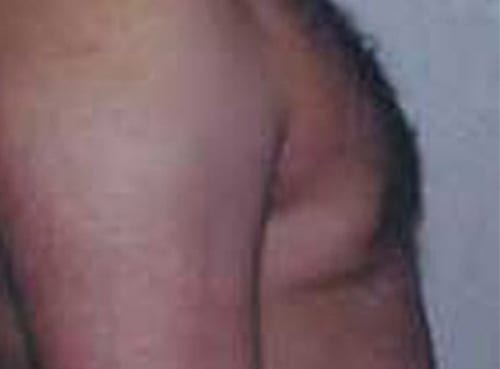 post op gynecomastia